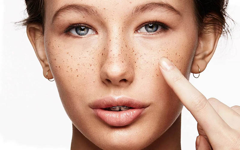 Детальніше про статтю Лікування гіперпігментації шкіри: вибір косметики