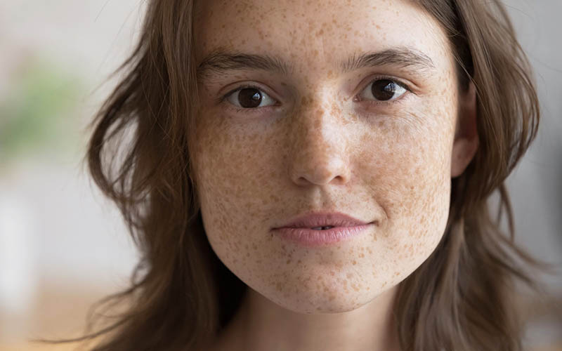 Ви зараз переглядаєте Причини виникнення гіперпігментації шкіри