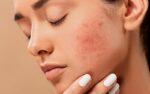 Терапія акне: види космецевтики для боротьби з акне