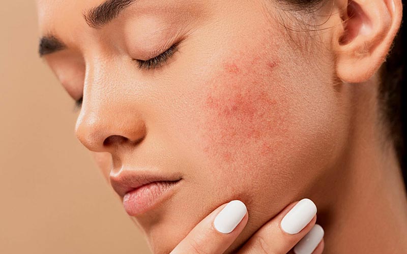 Ви зараз переглядаєте Терапія акне: види космецевтики для боротьби з акне